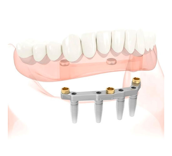 Overdenture